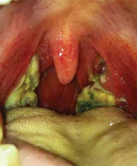 Figure Gas Pharyngitis What Youll See Download Scientific Diagram