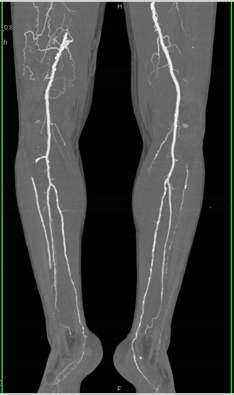 Cta Runoff With Occlusion Of The Right Superficial Femoral Artery Sfa