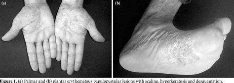 Figure 1 From New Onset Palmoplantar Psoriasis During Treatment Of