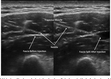 Figure From Myofascial Trigger Points New Insights In Ultrasound Imaging Semantic Scholar