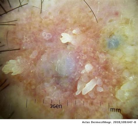 Tumor Collision Over Sebaceous Nevus Clues For Dermoscopic Diagnosis