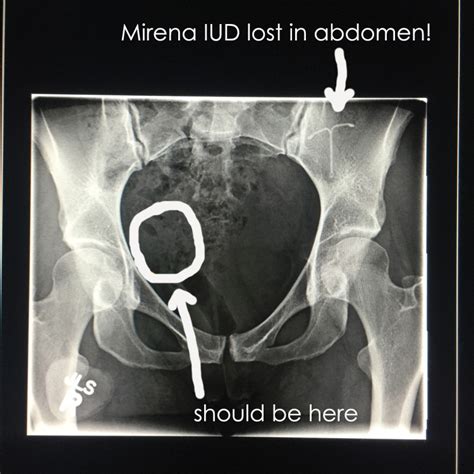 Let's answer these questions and learn about more about this. Mirena IUD Lost in Abdomen - One Little Minute Blog