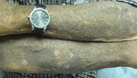 Blue Discoloration On Both Arms And Legs Clinical Advisor