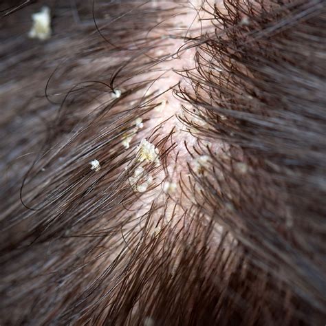 Whats Causing Seborrheic Dermatitis On Scalp All Rash Hot Sex Picture