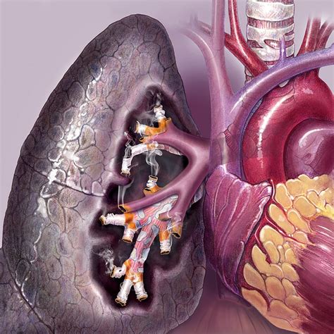 cigarette lungs illustration by applied art llc medical illustration and animation