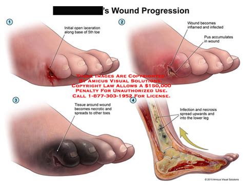 AMICUS Illustration Of Amicus Injury Initial Open Laceration 5th Toe