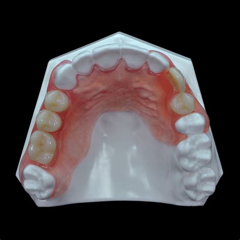 Partial Denture Upper Front Teeth
