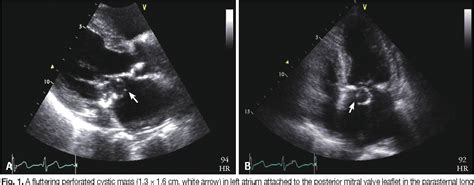 Perforated Aneurysm On The Posterior Leaflet Of The Mitral Valve My