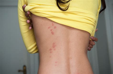 What Do Bed Bug Bites Look Like Welts My Xxx Hot Girl