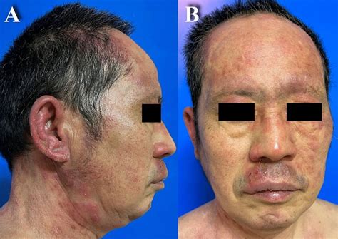 Tinea Incognito The Facial Erythematous Lesions With Pustules At The