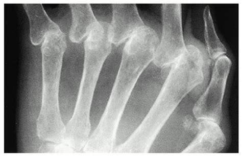 Symptoms include joint pain and swelling and stiffness. Rheumatoid Arthritis - Basic Science - Orthobullets