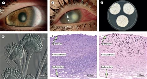 Contact Lens Related Fungal Keratitis The Lancet Infectious Diseases