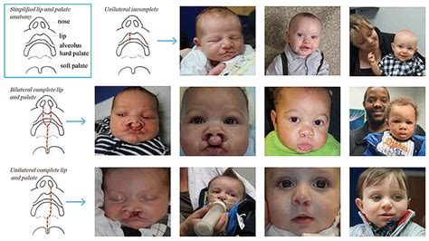 The Evolution Of Cleft Lip And Palate Surgery Childrens Hospital Of