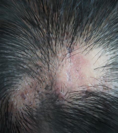 Scarring Alopecia Types