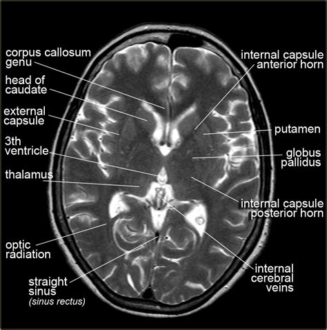 Mri Brain Anatomy Labeled