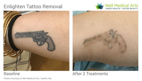 Top 77 Laser Tattoo Removal Before And After Latest Incdgdbentre