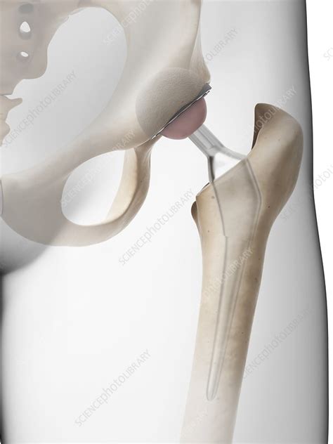 Human Hip Replacement Artwork Stock Image F009 6888 Science Photo Library