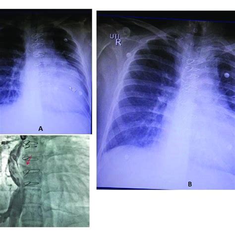 Chest Radiographs Showing Increased Heart Area Elongated Left