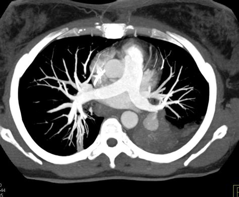 Pulmonary Artery Pseudoaneurysm Chest Case Studies Ctisus Ct Scanning