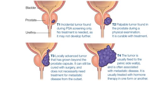 Metastatic Prostate Cancer Why Is My Cancer Staged The Waiting Room