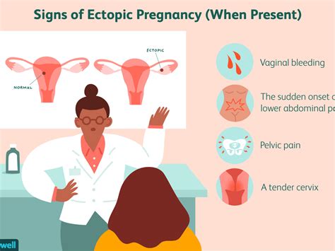 Left Ectopic Pregnancy Symptoms Pregnancysymptoms