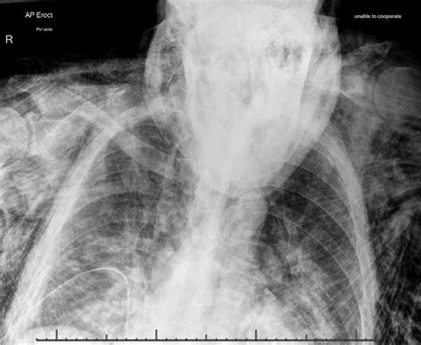 Chest X Ray Demonstrating A Basally Placed Intercostal Chest Drain With