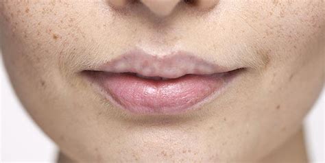 White Spots On Lips Symptoms Causes And Home Remedies