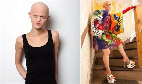 Woman With Rare Genetic Condition Ectodermal Dysplasia Becomes Model