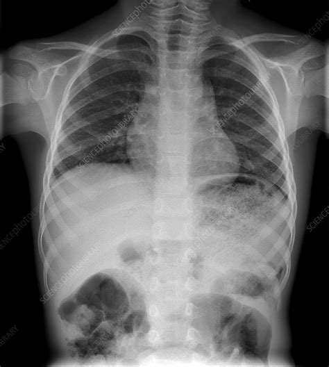 Swallowed Marble X Ray Stock Image C0177749 Science Photo Library