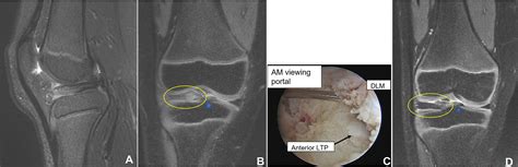Reliability Of MRI Interpretation Of Discoid Lateral Meniscus A Multicenter Study Emily L