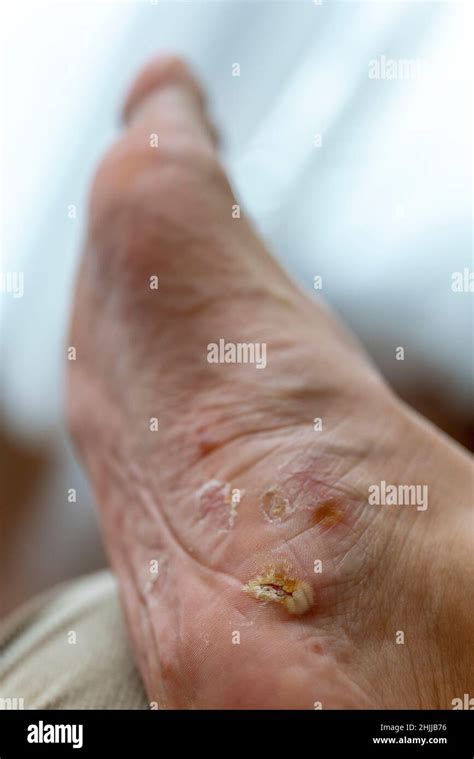 Scab And Itchy Hi Res Stock Photography And Images Alamy