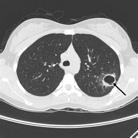 Chest Ct Showed A 3 Cm Cavitary Lesion In The Left Upper Lobe With