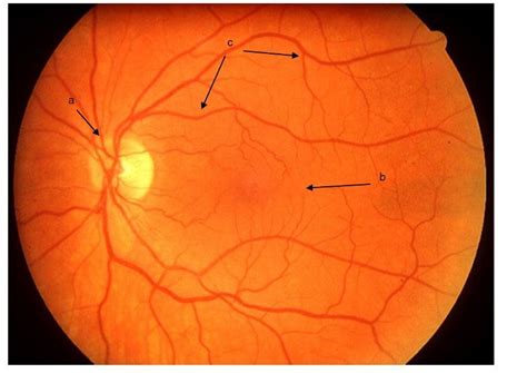 Clinical Retinal Photography Image Showing The Normal Appearance Of The