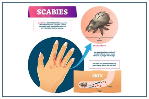 Demystifying Scabies Causes Symptoms Treatment And Prevention