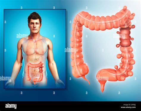 Diverticulosis Hi Res Stock Photography And Images Alamy