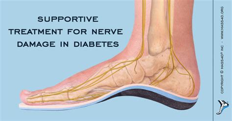 Treatment For Diabetic Peripheral Neuropathy Mass4d® Foot Orthotics