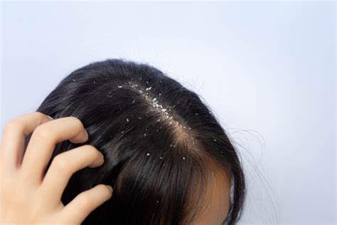 Scalp Yeast Infection Causes Symptoms And Treatment