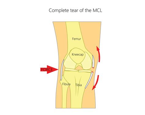 Grade 2 Medial Collateral Ligament Sprain Ankle Sprains Surgery Is