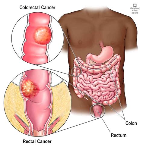 Cancer Rectal Ce Este Semne Etape și Tratament Medro