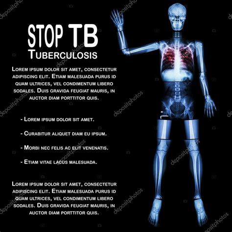 Knee Tuberculosis Of The Bone Cloudshareinfo