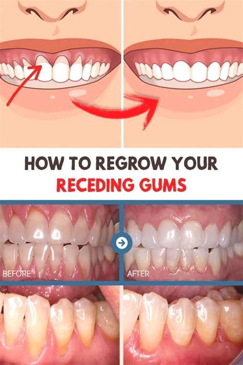 how to regrow your receding gums in 2020 receding gums gum care teeth health