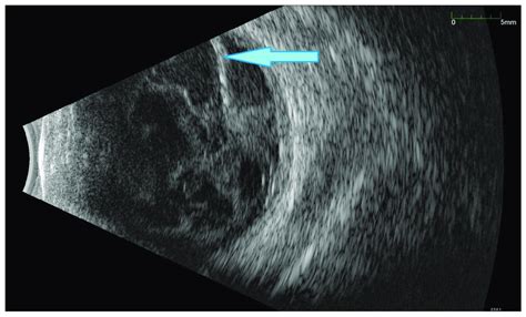 Ultrasound B Scan With Numerous Hyperechoic Densities In Vitreous