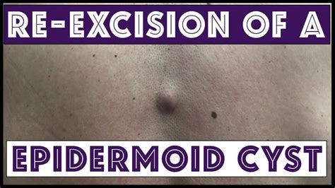 Re Excision Of A Cyst On The Lower Back Youtube