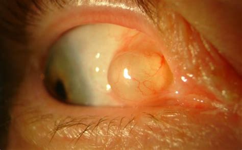 Cyst On Eyeball Inside Behind Causes Pictures Dermoid Small Clear