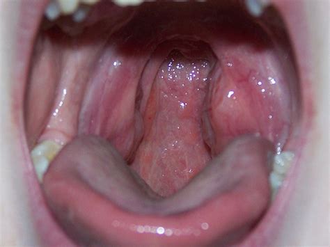 White Spot On Tonsil 7 Causes And How To Treat It Health Beauty Idea