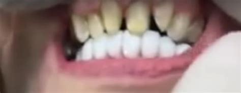 Jeffree Stars Teeth The Social Media Star Underwent Dental Surgery