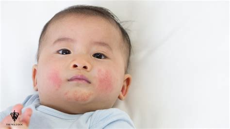 Eczema In Babies And Properly Testing Food Allergies Youtube