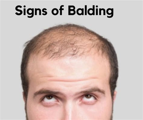 Recognizing The Early Signs Of Balding A Comprehensive Guide