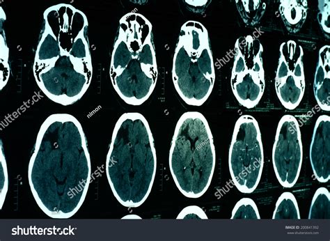 Computerized Tomography Ct Scan Brain Stock Photo 200841392 Shutterstock