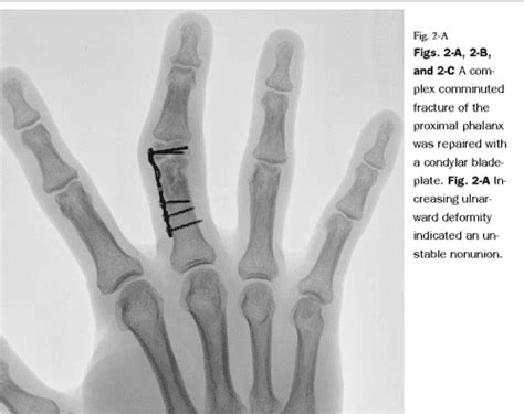 Malunion And Nonunion Of The Metacarpals And Phalanges Semantic Scholar